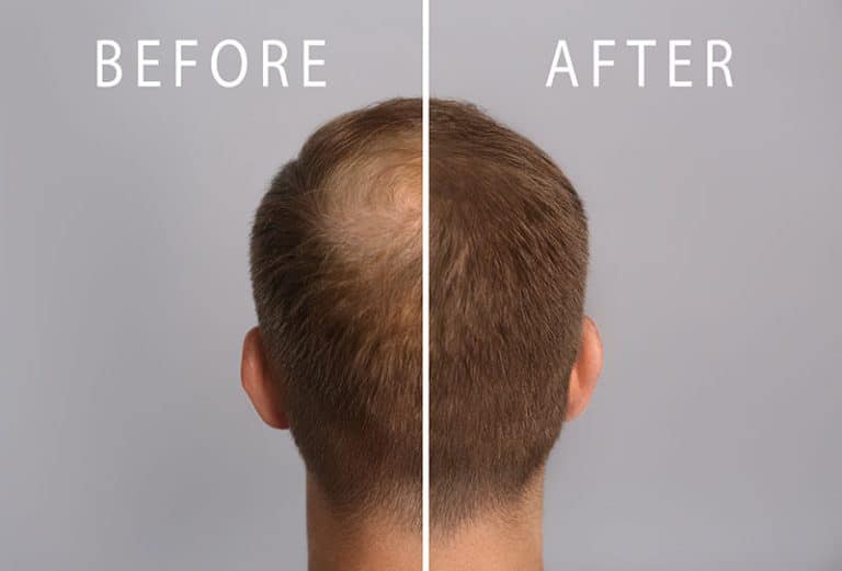 Hair Restoration Treatment | Non-Surgical Hair Loss Solutions ...