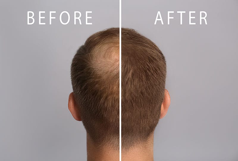 HAIR-LOSS-BEFORE-AFTER