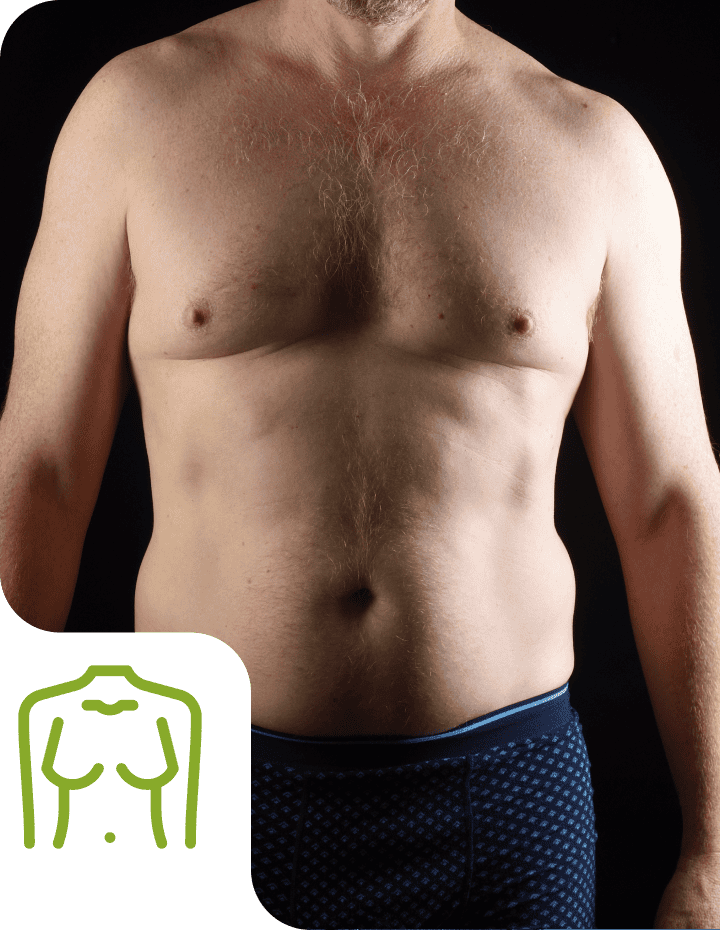 Gynecomastia-man